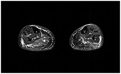 Radiomics and machine learning applied to STIR sequence for prediction of quantitative parameters in facioscapulohumeral disease